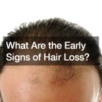 What Are the Early Signs of Hair Loss?